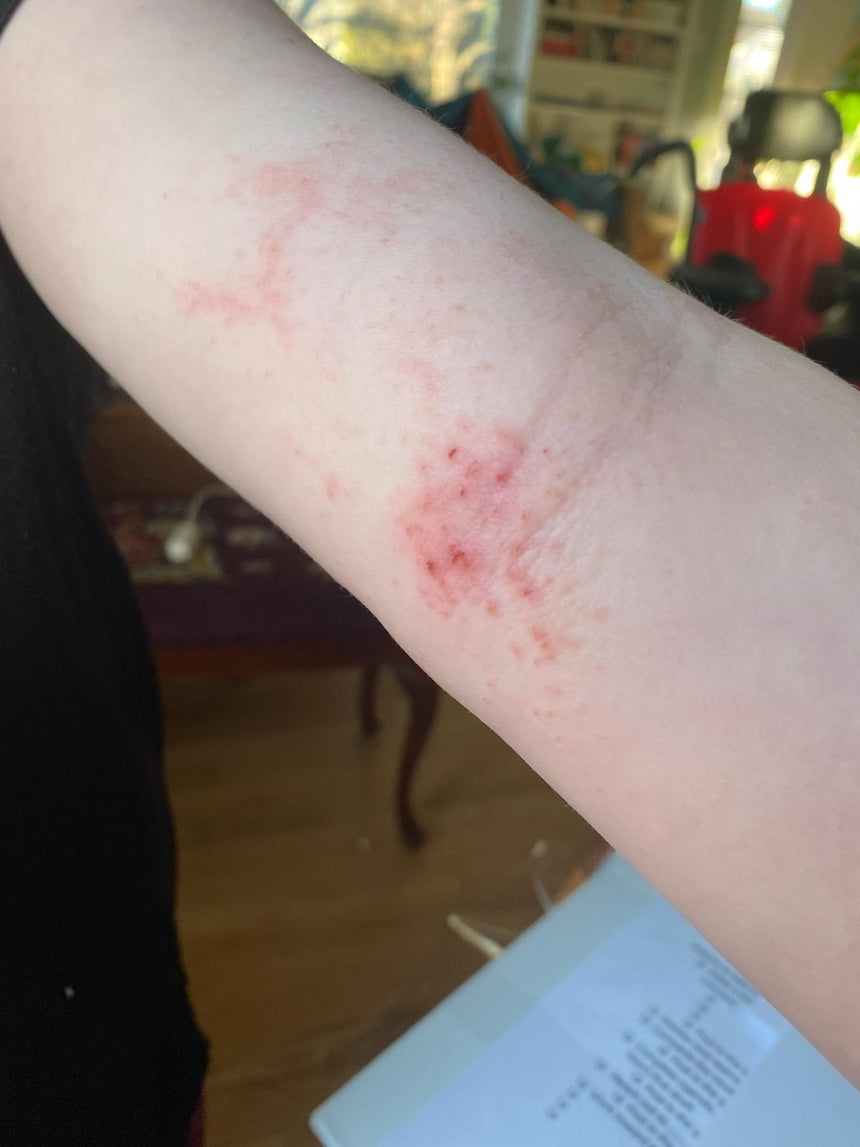 Before — Problem: Eczema
