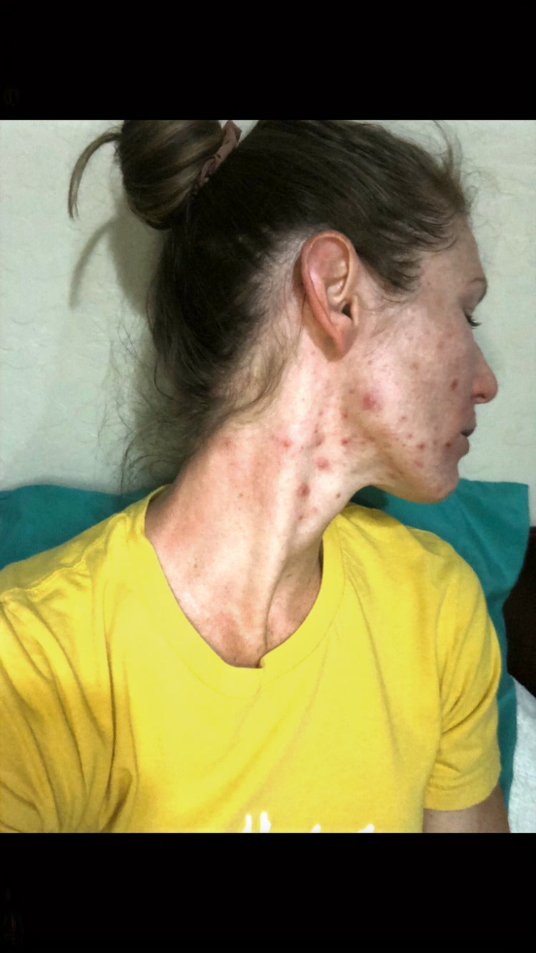 Before — Problem: Acne